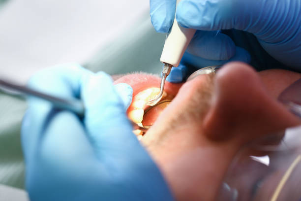 Best Emergency Dental Care for Abscessed Tooth in Binghamton, NY