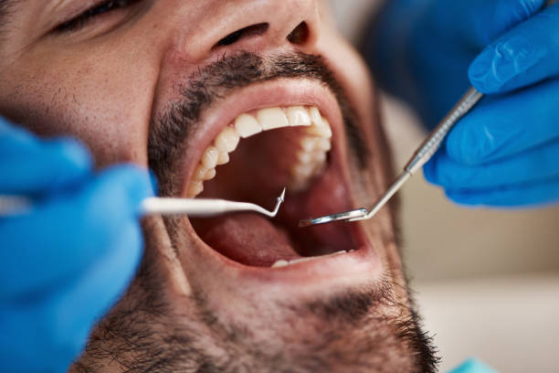 Best Emergency Dentist for Knocked-Out Tooth in Binghamton, NY