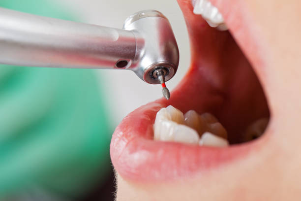 Best Broken or Cracked Tooth Emergency Dentist in Binghamton, NY